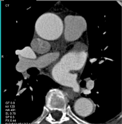 Plaque in LAD - CTisus CT Scan