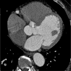 Focally Dilated RCA - CTisus CT Scan