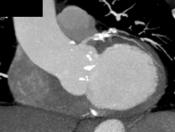 Focal Dilatation of the RCA With Remodeling - CTisus CT Scan