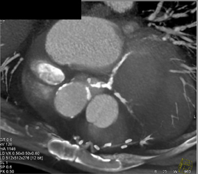 Diseased LAD and Circumflex Artery (CX) - CTisus CT Scan