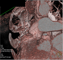 Left Internal Mammary Artery (LIMA) Graft Extends Behind Sternum - CTisus CT Scan