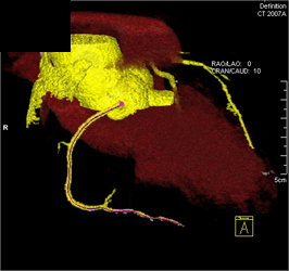 Normal RCA - CTisus CT Scan