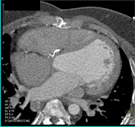 Repair of Ventricular Septal Defect (VSD) - CTisus CT Scan