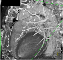 Patent Bypass Grafts - CTisus CT Scan