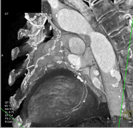 Patent Bypass Grafts - CTisus CT Scan