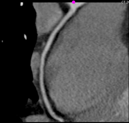 Normal RCA - CTisus CT Scan