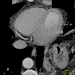 Normal RCA - CTisus CT Scan