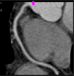 Normal RCA - CTisus CT Scan