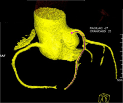 Plaque Without Critical Stenosis in LAD - CTisus CT Scan