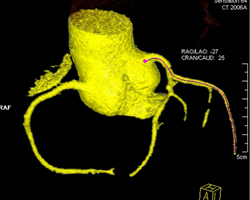 Plaque Without Stenosis in Circumflex Artery (CX) - CTisus CT Scan