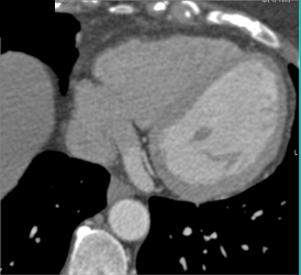 Small RCA With Left Dominant Circulation - CTisus CT Scan