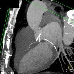 Calcified Plaque in LAD and Circumflex Artery (CX) - CTisus CT Scan