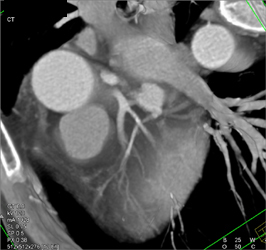 Minimal Plaque in Ramus Intermedius - CTisus CT Scan