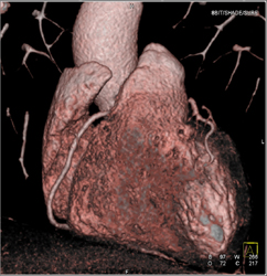 Normal RCA - CTisus CT Scan