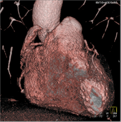 Various Intervals of 0-90% Show How RCA Changes With Sequence - CTisus CT Scan