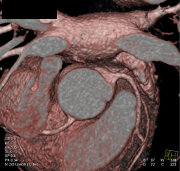 Normal RCA - CTisus CT Scan