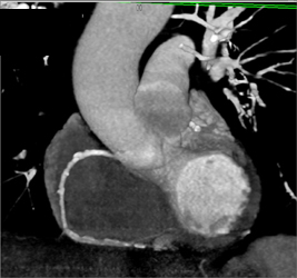 Extensive Plaque in RCA - CTisus CT Scan