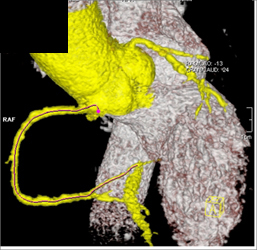 Plaque Without Critical Stenosis in RCA - CTisus CT Scan