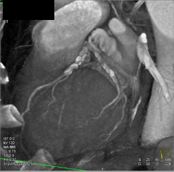 Extensive Plaque in LAD and Circumflex Artery (CX) - CTisus CT Scan