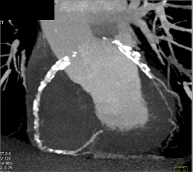 Multivessel Disease - CTisus CT Scan