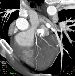 Pseudostenosis in LAD Due to Poor Rendering - CTisus CT Scan