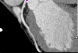 Soft Plaque and Myocardial Bridging - CTisus CT Scan