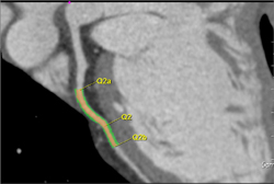 Automated Stenosis Detection - CTisus CT Scan