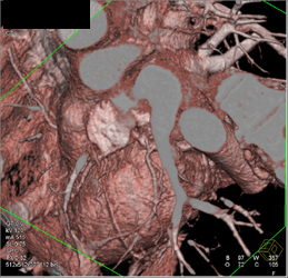 High Takeoff of Circumflex Off Right Cusp - CTisus CT Scan