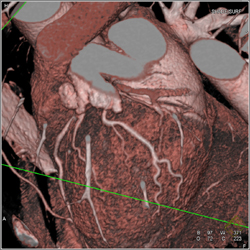 Normal LAD - CTisus CT Scan