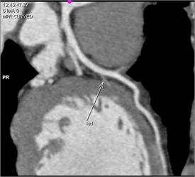 Normal LAD - CTisus CT Scan