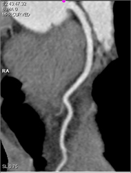 Normal LAD - CTisus CT Scan