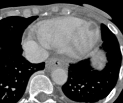 Clot in Left Ventricle From Old Mi-incidental Finding - CTisus CT Scan