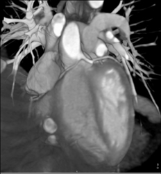 RCA Arises Off Left Cusp - CTisus CT Scan