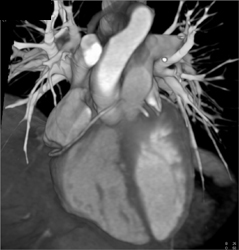 RCA Arises Off Left Cusp - CTisus CT Scan