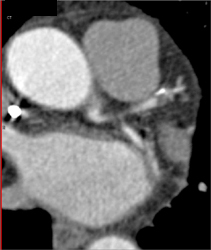 Diseased LAD and Circumflex - CTisus CT Scan