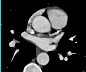 Diseased LAD and Circumflex - CTisus CT Scan