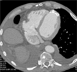 Old Infarct in Left Ventricle - CTisus CT Scan