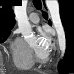 Normal Aortic Valve - CTisus CT Scan