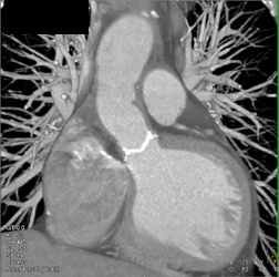 Normal Aortic Valve - CTisus CT Scan