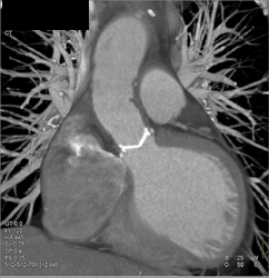 Normal Aortic Valve - CTisus CT Scan