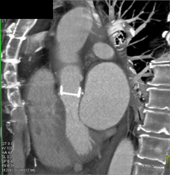 Normal Aortic Valve - CTisus CT Scan