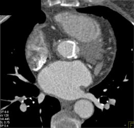 Normal Aortic Valve - CTisus CT Scan