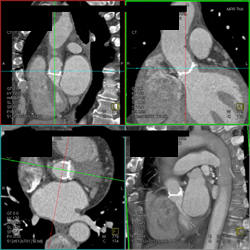 Normal Aortic Valve - CTisus CT Scan