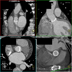 Normal Aortic Valve - CTisus CT Scan