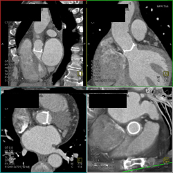 Normal Aortic Valve - CTisus CT Scan