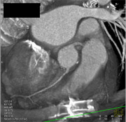 3D and 4d of Aortic Valve Replacement - CTisus CT Scan