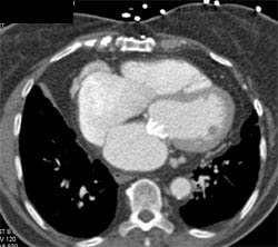 Mitral Valve Replacement - CTisus CT Scan