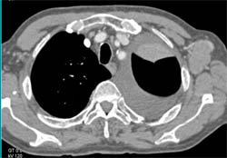 Lung Cancer Encases the Pulmonary Artery- Axillary Nodes Also Present - CTisus CT Scan