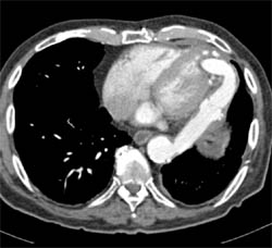 Graft From Aorta to Left Ventricle - CTisus CT Scan