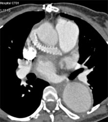 Bypass Graft to Pulmonary Artery - CTisus CT Scan